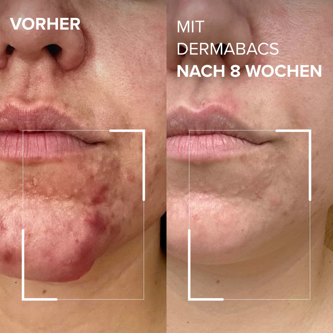 Vorher-Nachher Vergleich der Haut mit Dermabacs® nach 8 Wochen Unterschied im Hautbild erkennbar.