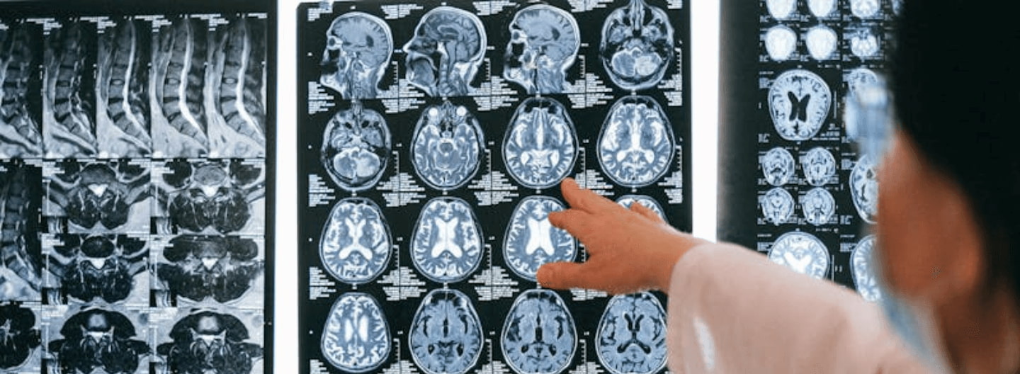 The blood-brain barrier