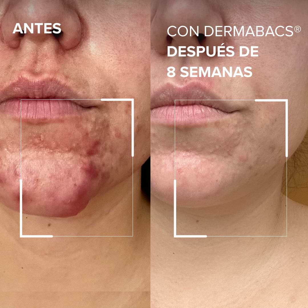 Dermabacs
