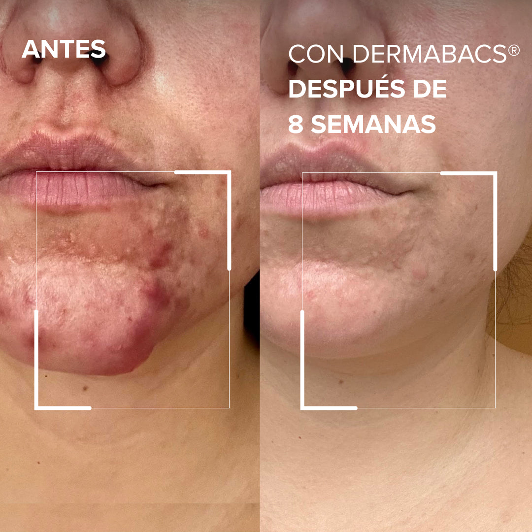 Dermabacs