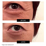 CurrentBody Skin RF ラジオ波 美顔器 楽天