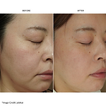 ZIIP HALO フェイシャルトーニングデバイス