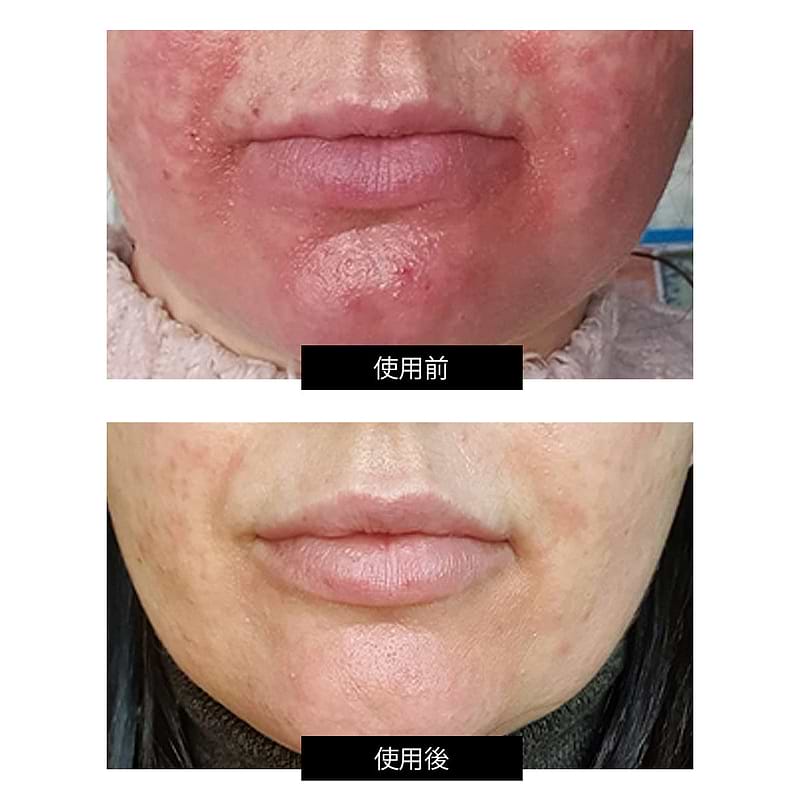 Dermalux フレックス MD