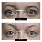 CurrentBody Skin RF ラジオ波 美顔器 楽天