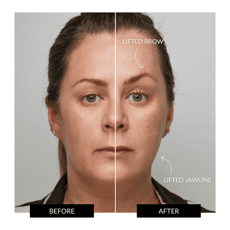 ZIIP HALO Facial Toning Device