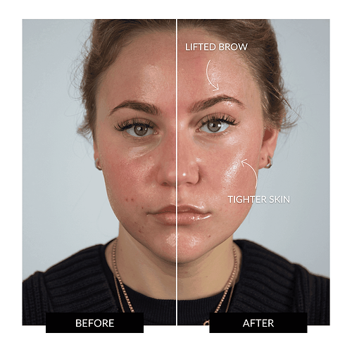 ZIIP HALO Facial Toning Device