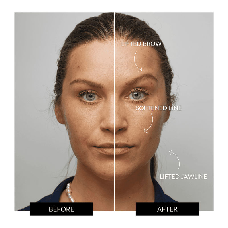 ZIIP HALO Facial Toning Device