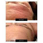 Dermalux Flex MD Dispositivo de Fototerapia com Luz de LED