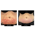 dermalux flex md resultados