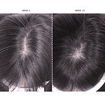 CurrentBody Skin LED Hair Regrowth Device Offer