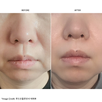 ZIIP HALO Facial Toning Device