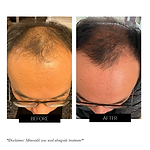 CurrentBody Skin LED Hair Regrowth Device Offer