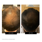 CurrentBody Skin LED Hair Regrowth Device Offer