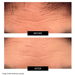 CurrentBody Skin RF Radio Frequency Skin Tightening Device Offer