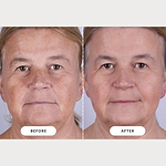 CurrentBody Skin LED Series 2 Face & Neck Kit - Memorial Day Offer