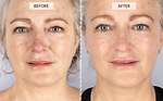 CurrentBody Skin LED Light Therapy Mask + 5 Hydrogel Masks