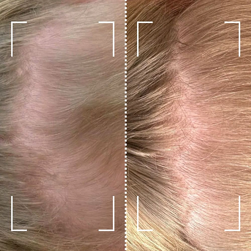 Improves androgenetic alopecia