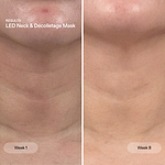 Before and after from using the LED Neck & Decolletage Mask for 8 weeks