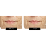 CurrentBody Skin LED Lip & Hydrogel Perfector Kit (10 Pack)