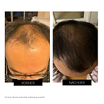 CurrentBody Skin LED Gerät gegen Haarausfall GQ