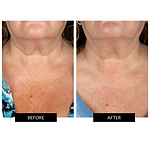 CurrentBody Skin LED Hals og Bryst Perfector