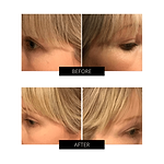 OXYjet GO Sistema facial de oxígeno