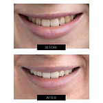 CurrentBody Skin Kit Extenso de blanqueamiento dental LED