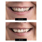 CurrentBody Skin Kit Extenso de blanqueamiento dental LED