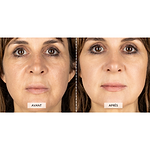 CurrentBody Skin Appareil radiofréquence + 2 recharges gel