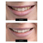 CurrentBody Skin - Kit de Blanchiment des dents LED Offre