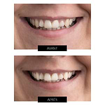 CurrentBody Skin - Kit de Blanchiment des dents LED Offre