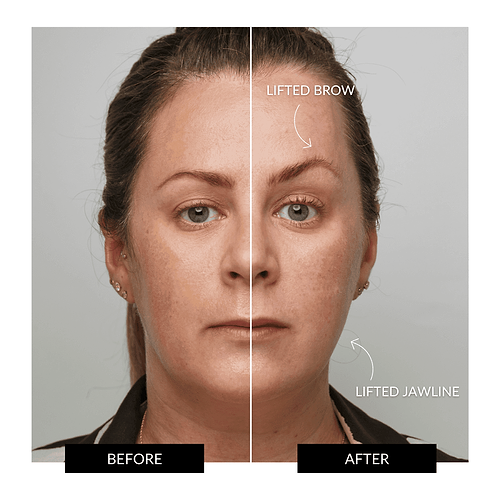 ZIIP HALO Facial Toning Device