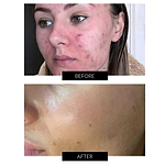 Dermalux Flex MD LED Light Therapy Device