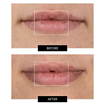 CurrentBody Skin LED Lip Perfector