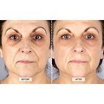 CurrentBody Skin RF Radio Frequency Skin Tightening Device