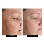 Dermalux Flex MD LED Light Therapy Device