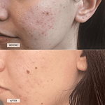 CurrentBody Skin Anti-Blemish LED Face Mask