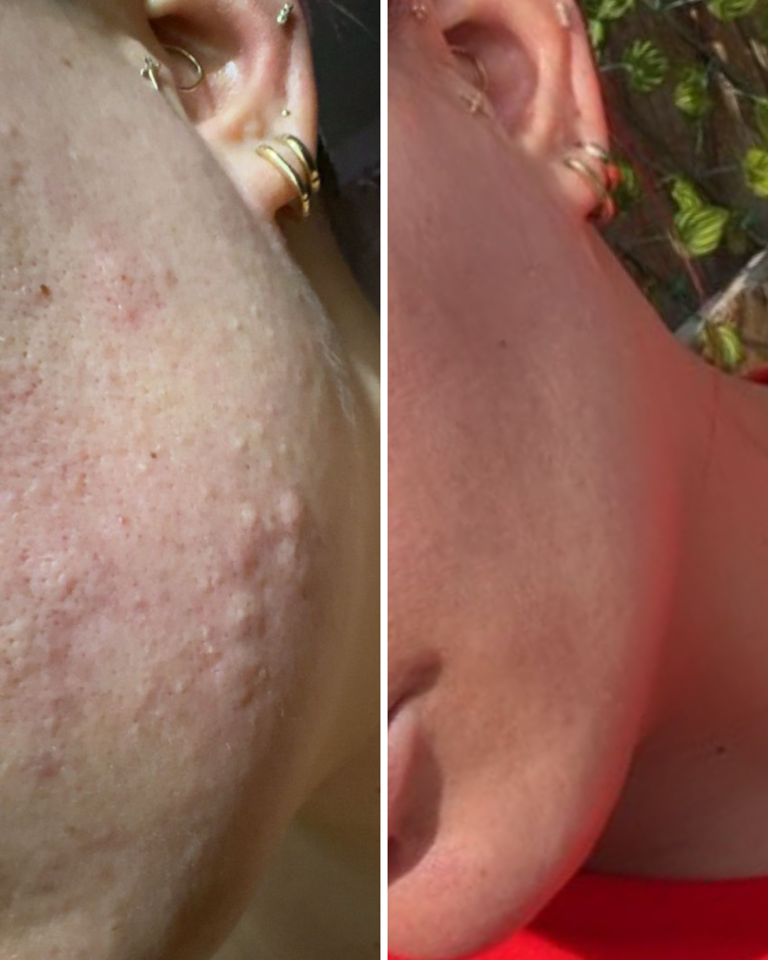 Acne e macchie
