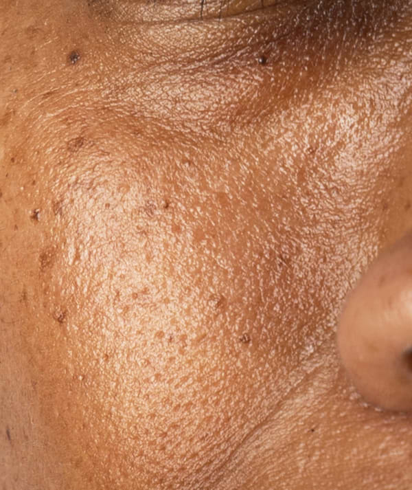 Pigmentation