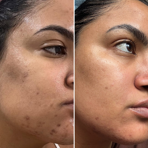 Before and after comparison showing a brighter-looking complexion