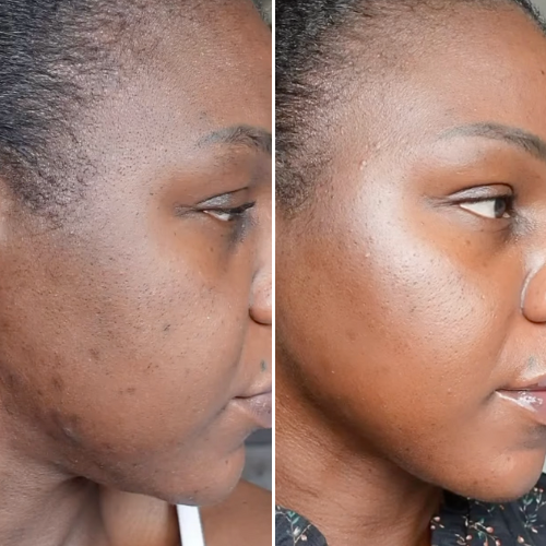 Before and after comparison showing a more even-looking skin tone