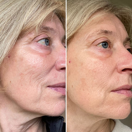 Before and after comparison showing reduced-looking fine lines
