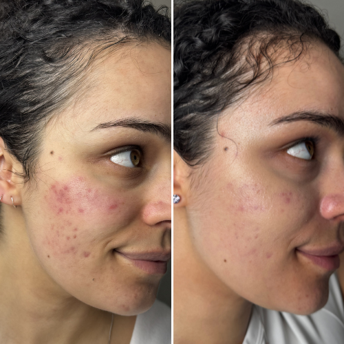 Before and after comparison showing reduced-looking redness