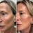 Reduces fine lines & wrinkles