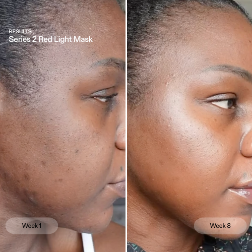 Before and after from using the CurrentBody Series 2 Red Light Mask