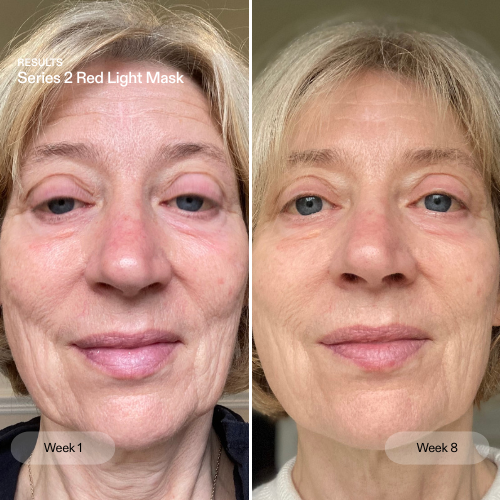 Before and after from using the Series 2 Red Light Mask for 8 weeks