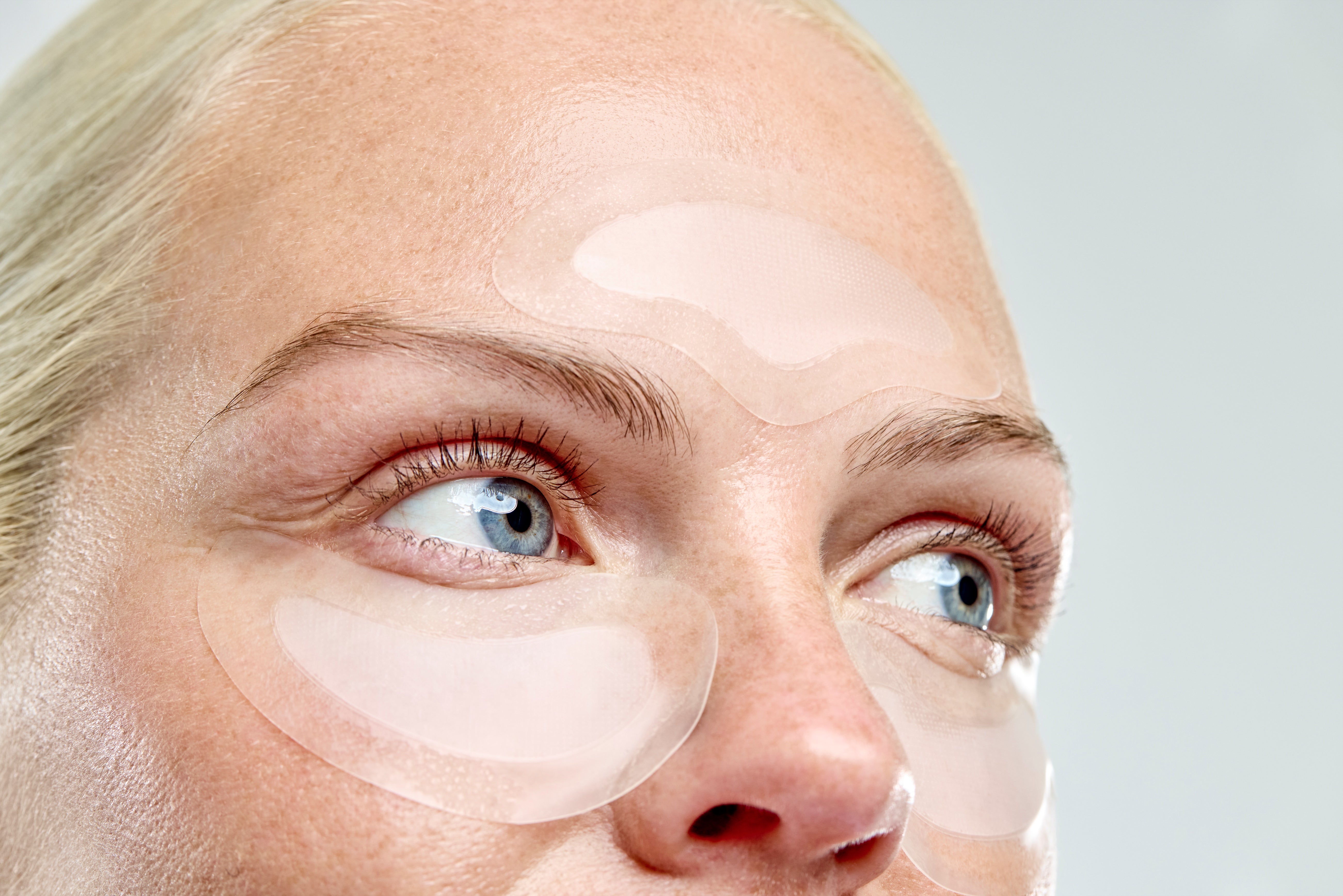 Microneedling