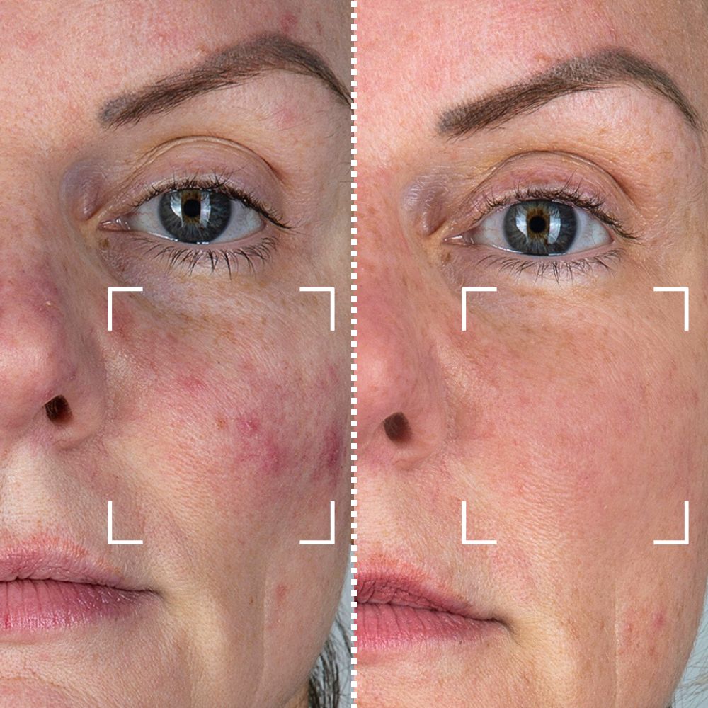 Reduce líneas finas y arrugas