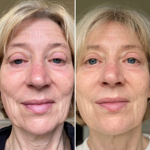 


Before &amp; After
