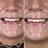 Whitens teeth by up to 6 shades